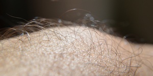 skin and hair bioburden die cutting